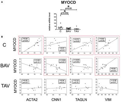 Mechanisms of Smooth Muscle Cell Differentiation Are Distinctly Altered in Thoracic Aortic Aneurysms Associated with Bicuspid or Tricuspid Aortic Valves